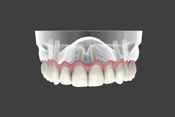 Are Implant Supported Dentures Permanent from Family Choice Dental in Albuquerque, NM