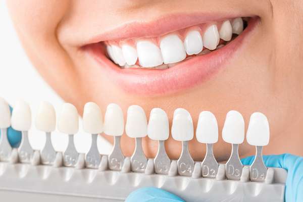 Ask a Cosmetic Dentist: What Are Veneers from Family Choice Dental in Albuquerque, NM