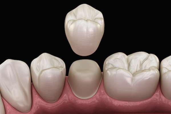 What To Ask Your General Dentist When Preparing for a Crown from Family Choice Dental in Albuquerque, NM