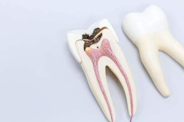 Ask a General Dentist: Is a Tooth Dead After a Root Canal from Family Choice Dental in Albuquerque, NM