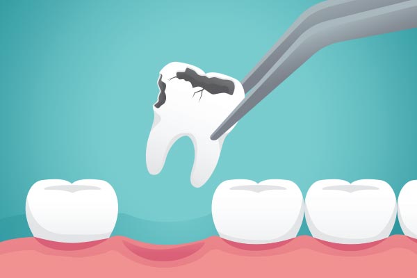 Ask a General Dentist: What Happens to Your Tooth After Extraction from Family Choice Dental in Albuquerque, NM