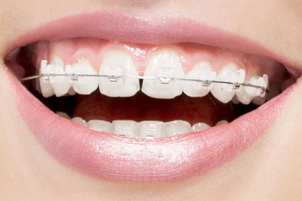 Are Clear Braces And Clear Aligners The Same?