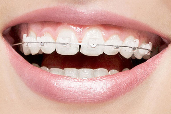 Ceramic Braces Vs. Invisalign