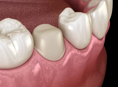 Dental Crowns and Dental Bridges Albuquerque, NM