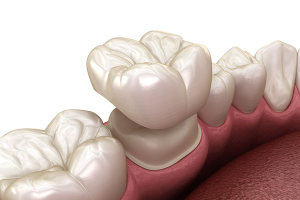 What Can Dental Crowns Do for Your Oral Health Issues? from Family Choice Dental in Albuquerque, NM