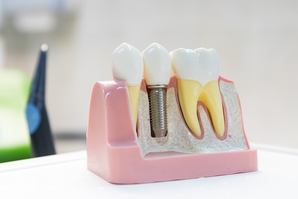 Can A Dental Implant Restoration Replace A Lost Tooth?