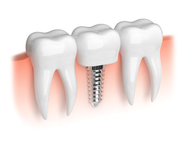 The Dental Implant Procedure: How An Implant Dentist Can Replace Your Dentures