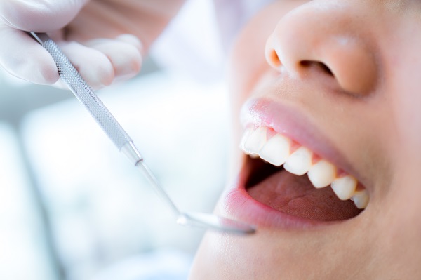 Important Facts About Dental Sealant Placement