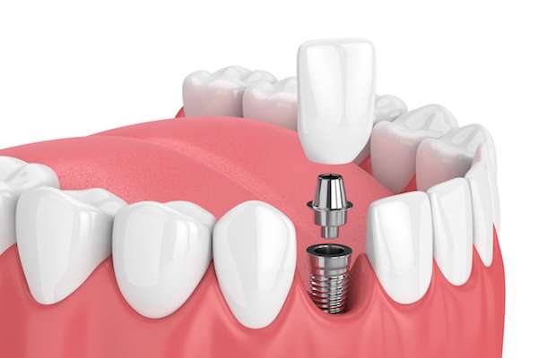 How Painful is Dental Implant Surgery from Family Choice Dental in Albuquerque, NM