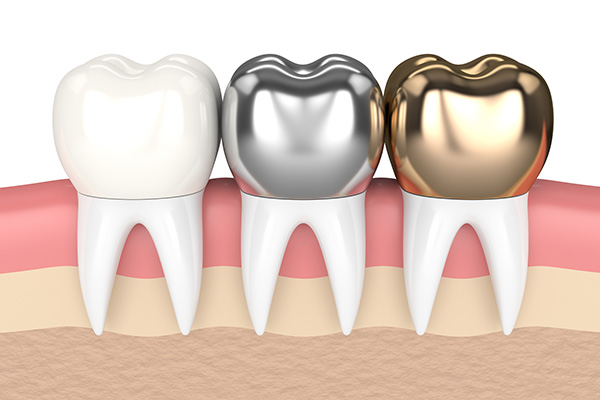 Metal Crowns vs. Porcelain Dental Crowns from Family Choice Dental in Albuquerque, NM