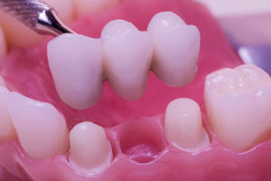 5 Reasons You May Have A Loose Dental Crown