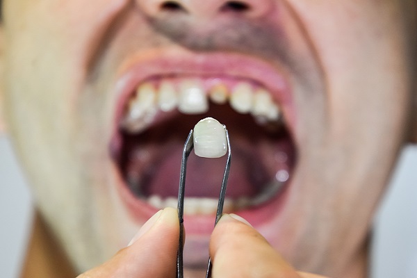 Options For Replacing Missing Teeth: Cosmetic Dental Replacements