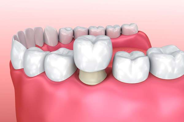 Permanent Dental Crowns vs. Temporary: Is There a Difference from Family Choice Dental in Albuquerque, NM