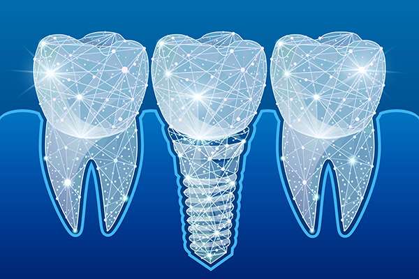 Preventing Complications After Getting Dental Implants from Family Choice Dental in Albuquerque, NM