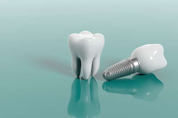 Multiple Teeth Replacement Options: One Implant for Two Teeth from Family Choice Dental in Albuquerque, NM