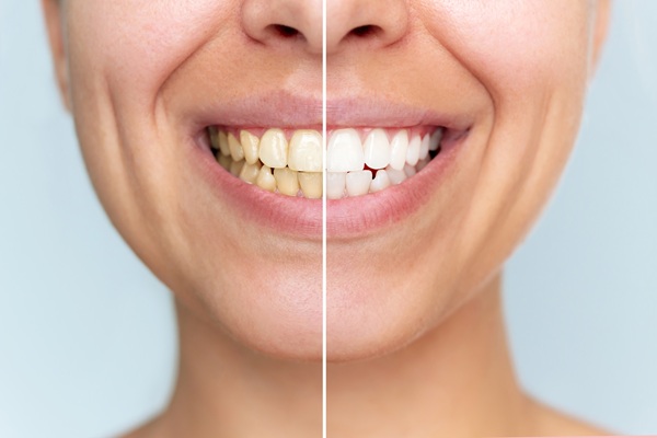 Professional Teeth Whitening Vs  At Home Kits: What Works Best?