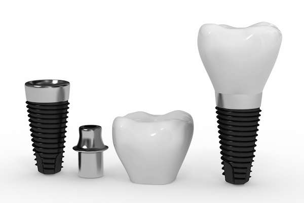What Are the Parts of Dental Implants from Family Choice Dental in Albuquerque, NM
