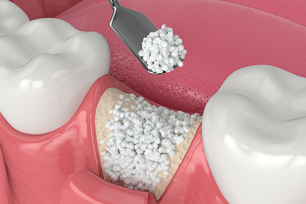 When a Bone Graft Is Needed for an Implant Dentistry Procedure from Family Choice Dental in Albuquerque, NM