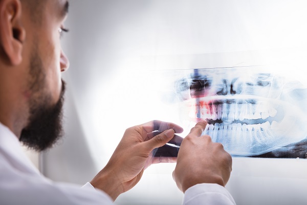 Wisdom Tooth Extractions: How Do You Know If Your Wisdom Teeth Need To Come Out?