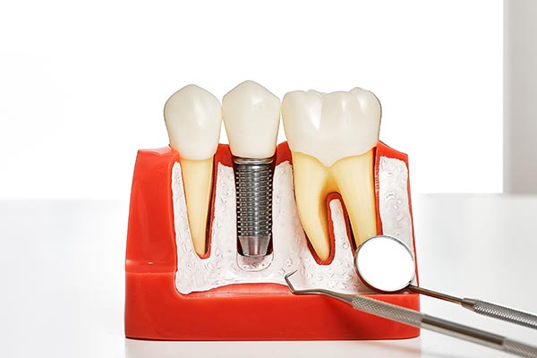 Your Guide to Different Kinds of Dental Implants from Family Choice Dental in Albuquerque, NM