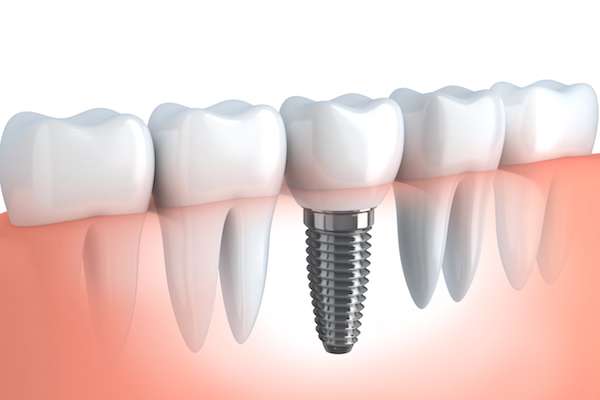 Your Ultimate Guide to Getting Dental Implants from Family Choice Dental in Albuquerque, NM